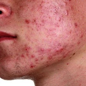 Pokud akné dojde až do takového stádia, vyhledejte pomoc dermatologa
