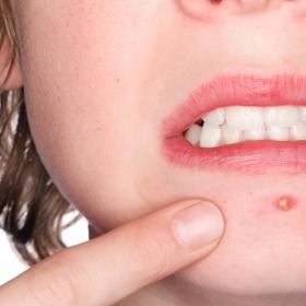 Na hnisající pupínky pozor