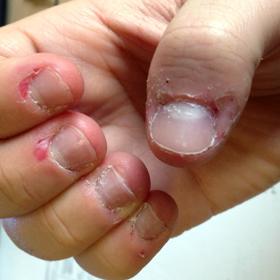 Nehty a stav kůže okolo nich svědčí o vašem zdravotním stavu