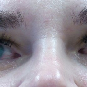 Slzení očí poukazuje na alergii na lepidlo na řasy