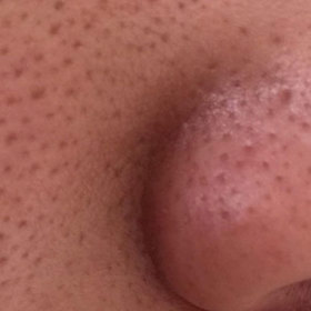 Rozšířené póry trápí mnoho z nás