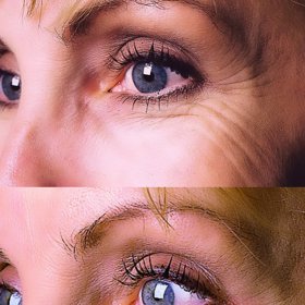 Pokud podstoupíte aplikaci botulotoxinu, musíte počítat s tím, že efekt vydrží jen 3 až 5 měsíců.