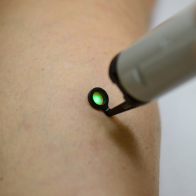 Barvivový laser na odstraňování mikrovarixů.