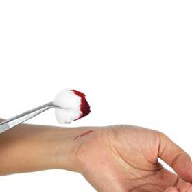 Hemofiliky trápí dlouhé a neřízené krvácení