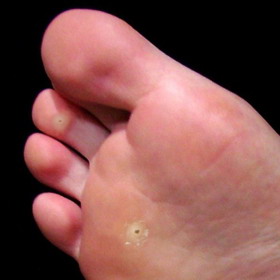 Kuří oka vznikají z nepohodlné obuvi