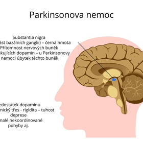 Jak vypadá Parkinsonova nemoc?