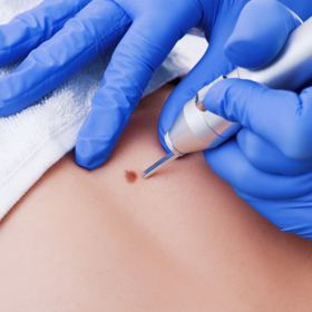 Pihy si můžete nechat odstranit různými způsoby.