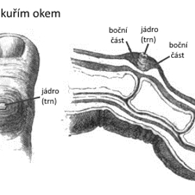 Takhle vypadá prst s kuřím okem.