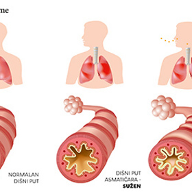 Astmatem trpí 300 milionů lidí na světě