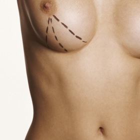 K nejčastějším operacím patří plastika prsu.