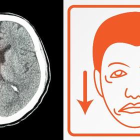 Jak probíhá mozková mrtvice?