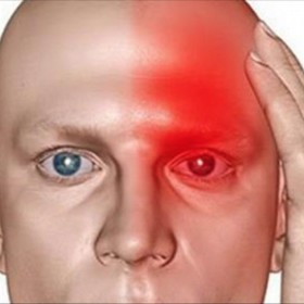 Tichá mozková příhoda může potkat každého z nás