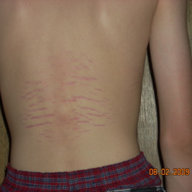 Strie se mohou objevit například i u dospívajících, kteří příliš rychle vyrostou.