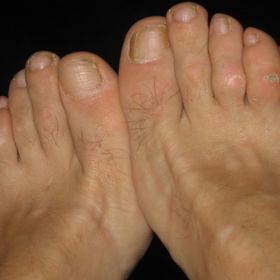 Takhle vypadá noha s kuřími oky na prstech a dalšími kožními i ortopedickými problémy.