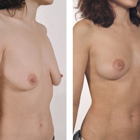 
Stav PŘED a PO modelací prsů