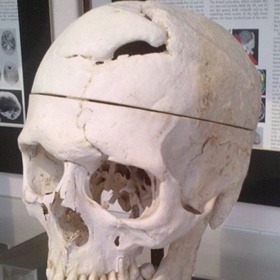 Lebka Phinease Caga, která dokazuje, co všechno může lidské tělo a jeho mozek přežít, je nyní vystavena ve Warrenově anatomickém muzeu.