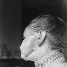 K osteonekróze čelisti docházelo v 19. století u zaměstnanců továren, kteří pracovali s fosforem. 