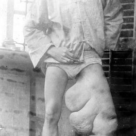 ...jakmile ucpou lymfatický systém, začnou vznikat děsivé otoky ne nepodobné sloní noze.