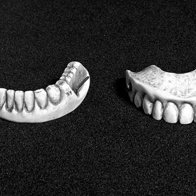 Zubní náhrady se v osmnáctém století vyráběly ze skutečných zubů. Mrtvým vojákům je vytrhávali zloději, kteří je poté prodávali lékařům. 