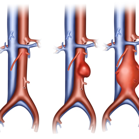 Aortální aneurysma nejčastěji vzniká v oblasti břicha. Růst může i léta, než praskne. Mezi rizikové faktory patří genetická predispozice, mužské pohlaví, věk, kouření, dilatační typ aterosklerózy, vysoký tlak, neinfekční aortitis atd.