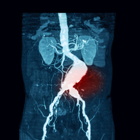 CT angiografický snímek prasklého aortálního aneurysmatu.