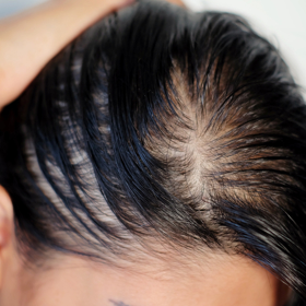 Problém nastává ve chvíli, kdy vám vlasy začnou vypadávat v chomáčcích z jednoho místa.