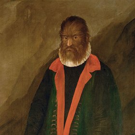 Petrus Gonsalvus trpěl hypertrichózou, která způsobuje nadměrný růst ochlupení. Petrus žil jako šlechtic u francouzského dvora, oženil se a měl sedm dětí.