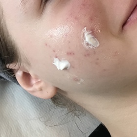 Pleti je potřeba dopřát především dostatečnou hydrataci. Použít můžete i lokální přípravky na akné.