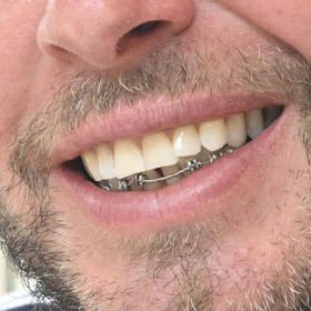 Moderátor Jan Tuna se Lifee.cz pochlubil novými rovnátky na spodních zubech.