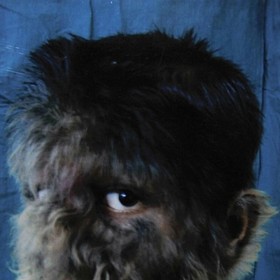 vlkodlačí syndrom je nadměrný růst ochlupení