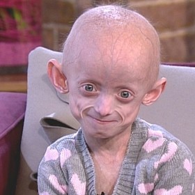 Předčasné stárnutí. Děti se nedožijí ani 15 let.