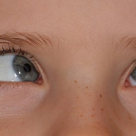 Šilhání by se mělo vyřešit před nástupem do školy