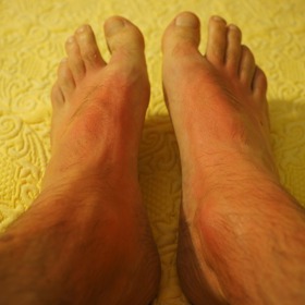 S opalováním není dobré si zahrávat. Může skončit bolestivě.