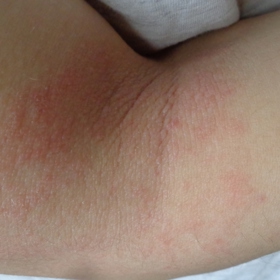 Ekzém v loketní jamce bývá běžný.