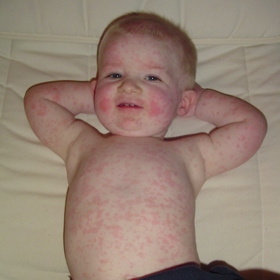 Mažte své děti speciální kosmetikou pro atopiky.