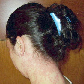 U dospělých se ekzém většinou objeví jako první na krku.