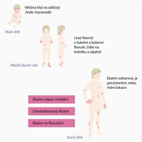 Jak vypadají různé druhy ekzému?