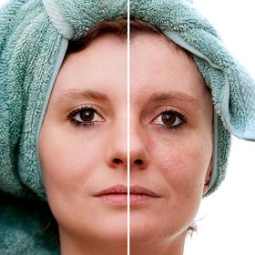 Tmavé skvrny mohou z vaší pleti zmizet snadno a rychle.