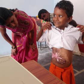 Holčička, jejíž maminka se polila benzínem a upálila. Malá ji chtěla zachránit a objala ji. Následky vidíte sami.