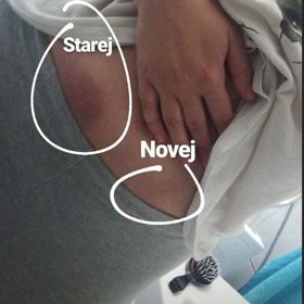 Po vpichu se většinou vytvoří nepěkný flek nebo modřina.