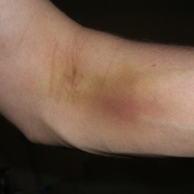 Anémie způsobuje náchylnost k modřinám