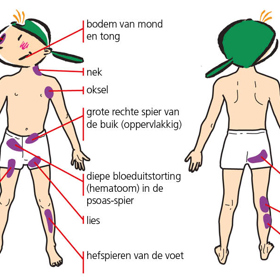 Jaké jsou příznaky hemofilie?