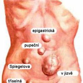 Kýla může vzniknout všude.
