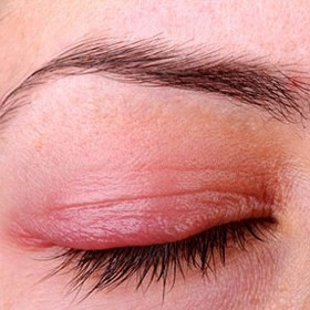 Červená víčka mohou značit alergii nebo používáte nevhodný odličovač očí