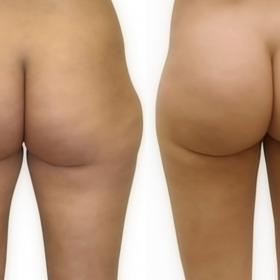 Rozmáhá se i trend zpevňování zadečku vlastním tukem