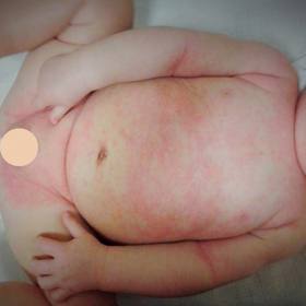 U dětí s atopickým ekzémem dbejte rad lékaře.