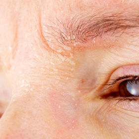 Ekzém se může dělat i okolo očí.