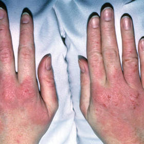 Nejčastěji se ekzém objevuje na rukách.