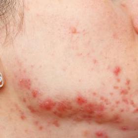 Ženy jsem nešťastné, když jejich obličej hyzdí ekzém či jiný vyrážka.