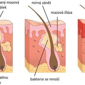Jak vypadá pokožka s akné